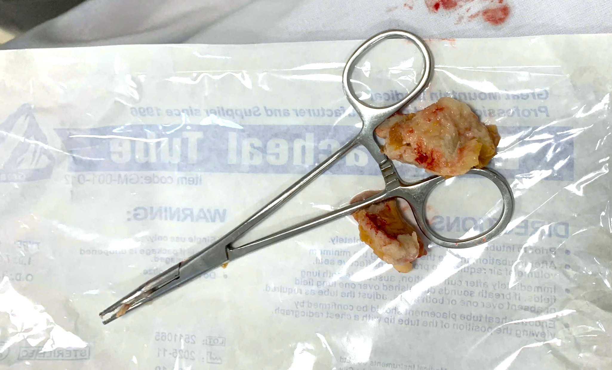 Cấp cứu kịp thời cho bệnh nhân cao tuổi bị suy hô hấp do dị vật đường thở